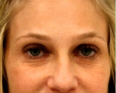 Feel Beautiful - Blepharoplasty Upper/Lower Eyelids 106 - Before Photo